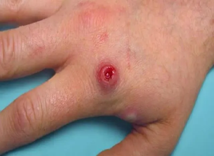 Suprasti „Monkeypox“ ir kaip išvengti jo？
