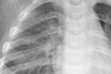 Greitas chlamydia pneumoniae aptikimas: patikimas ir efektyvus